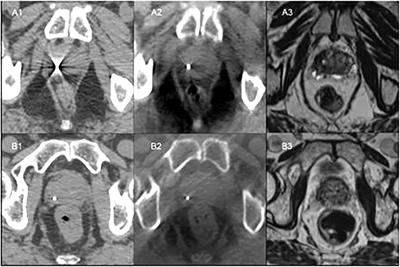 A clinical study comparing polymer and gold fiducials for prostate cancer radiotherapy